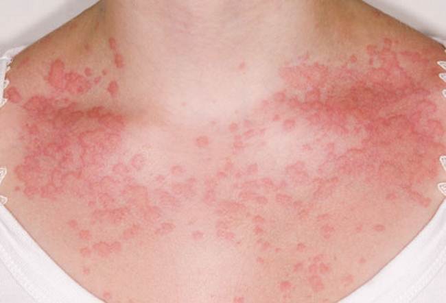 Сыпь на теле или аллергический дерматит