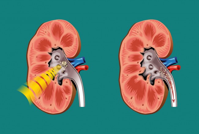 lithotripsy in kidney stones