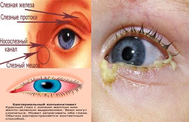 Гноение глаз, причины и лечение болезни