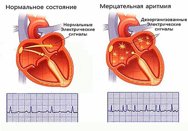 Аритмия на кардиограмме больного