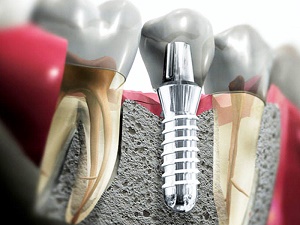 implantaziya-zubov