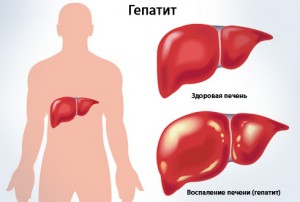viral-hepatitis-b