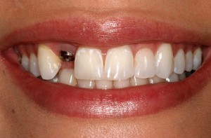 implanty-zubov-otzyvy-vred-i-protivopokazaniya-2