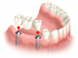 dental-bridge-on-implants