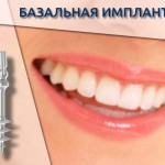Базальная имплантация