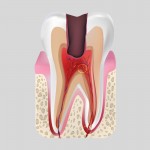 Пульпит – заболевание зубов, нуждающееся в экстренном лечении