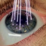 Преимуществап лазерной коррекции зрения методом Фемто-Ласик