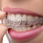 Преимущества элайнеров