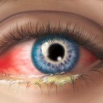 Что такое конъюнктивит глаз