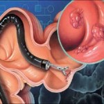 Колоноскопия: современная диагностика здоровья кишечника